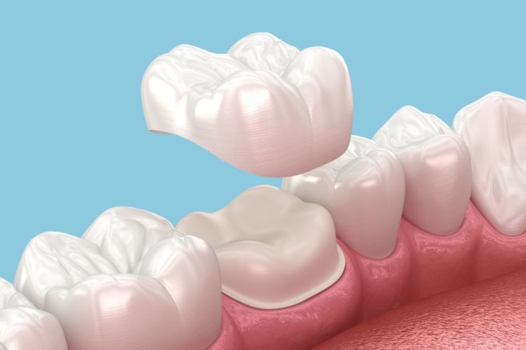 Dental Crowns